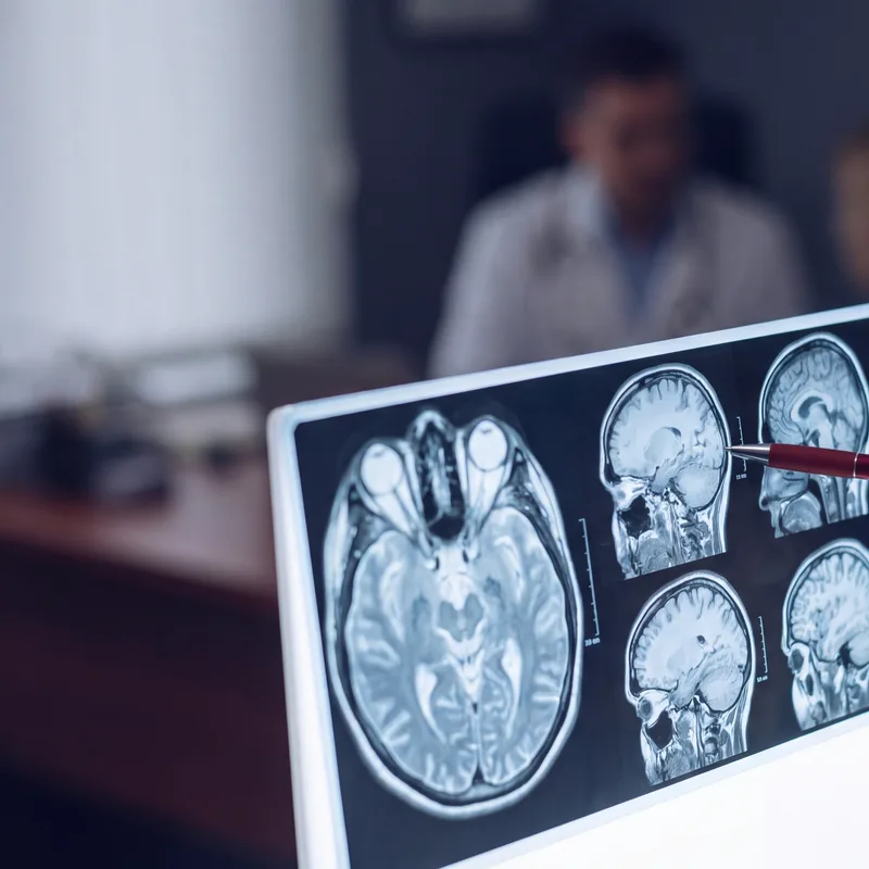 Gloved hand with a crimson pen reviewing brain MRI scans on a backlit medical lightbox
